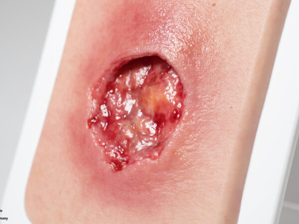 Pocketwound Undermining - Image 4