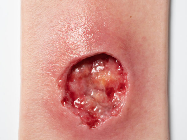 Pocketwound Undermining - Image 5