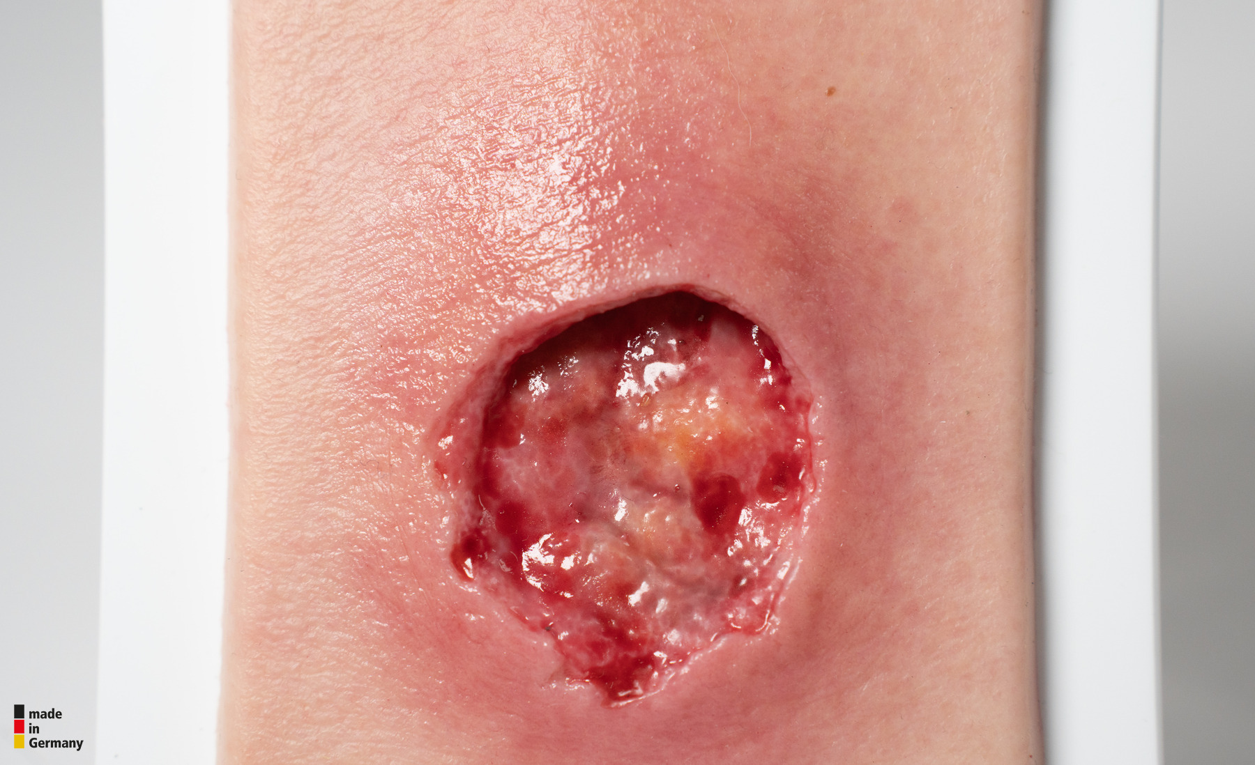 Pocketwound Undermining - Image 5