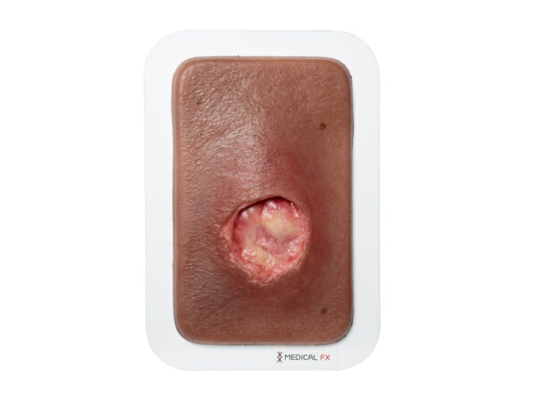 Pocketwound Undermining - Image 8