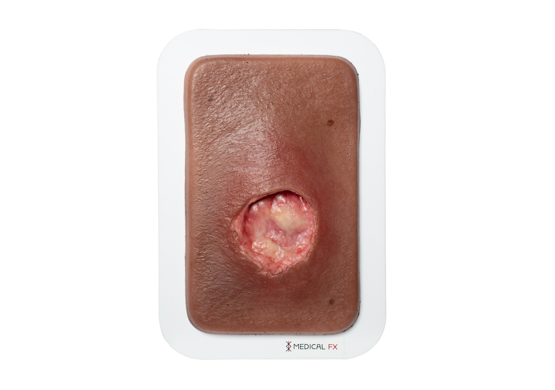 Pocketwound Undermining - Image 8