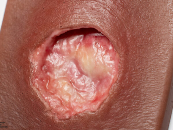 Pocketwound Undermining - Image 6