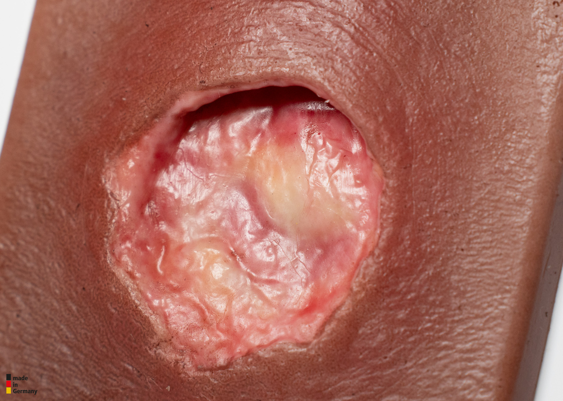 Pocketwound Undermining - Image 6