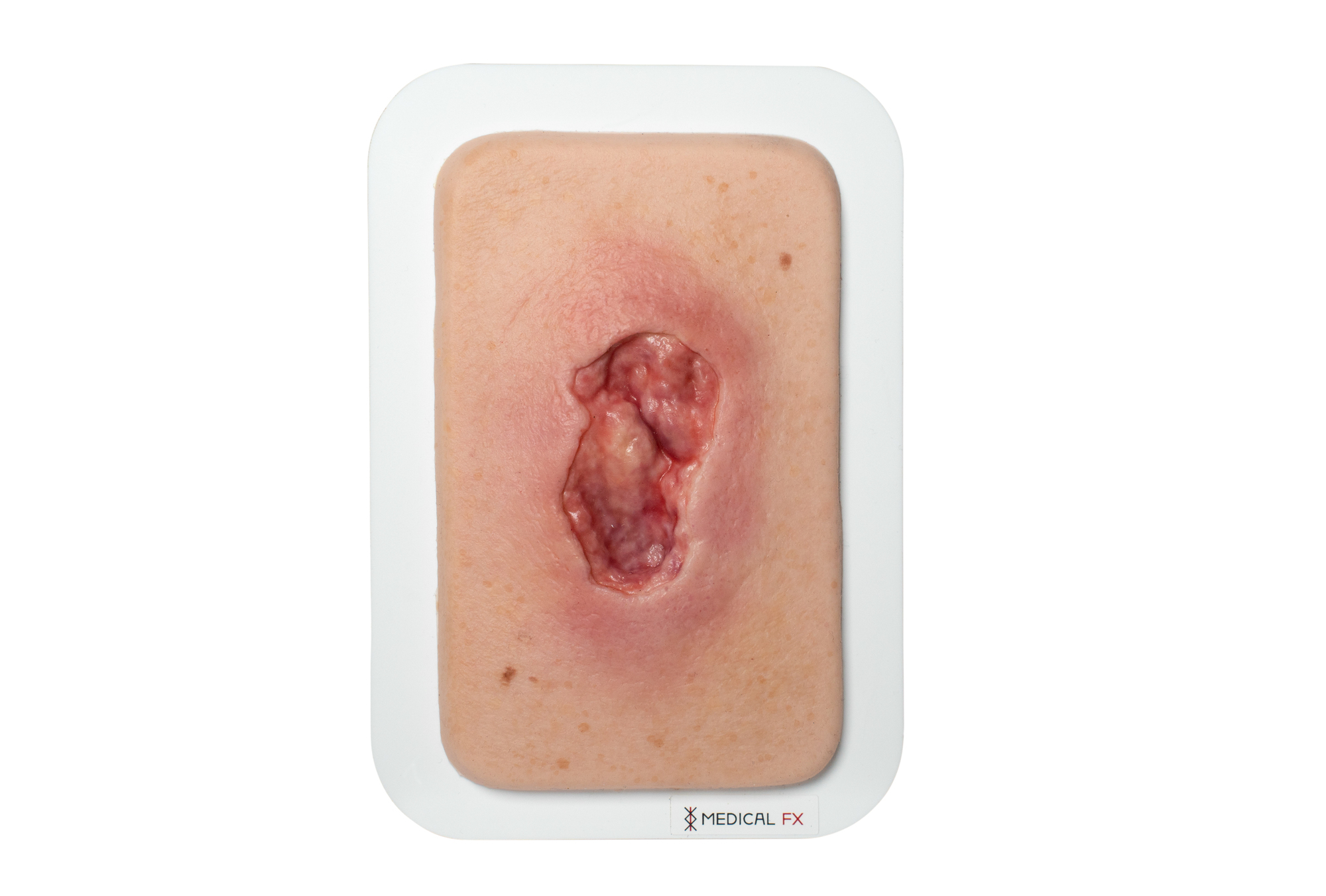 Pocketwunde Dekubitus – Bild 1