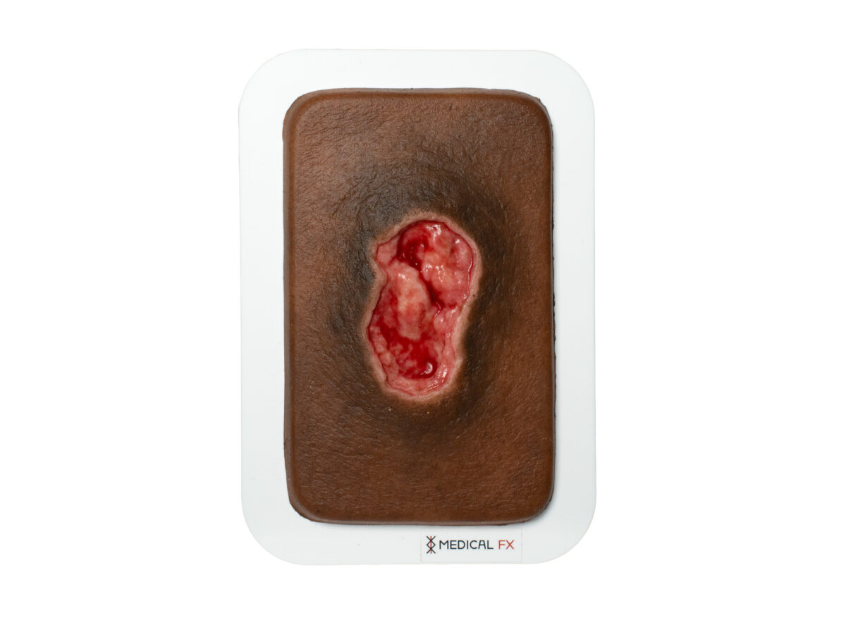 Pocketwunde Dekubitus