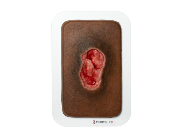 Pocketwunde Dekubitus – Bild 7
