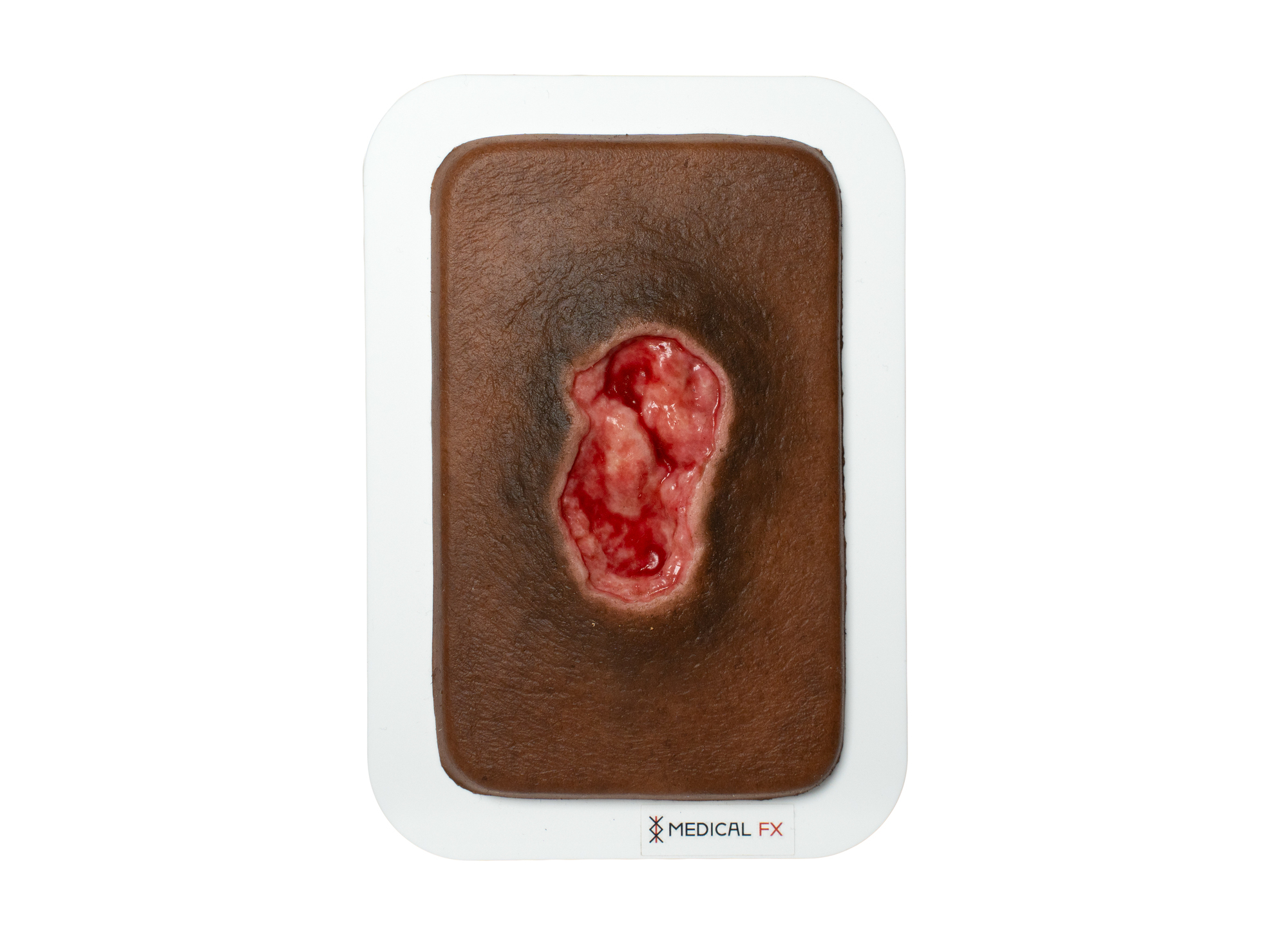 Pocketwunde Dekubitus – Bild 7