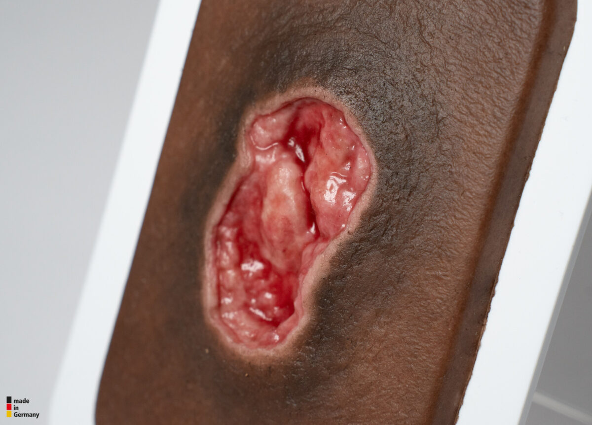 Pocketwound Úlcera por Presión