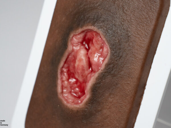 Pocketwound Úlcera por Presión - Image 3