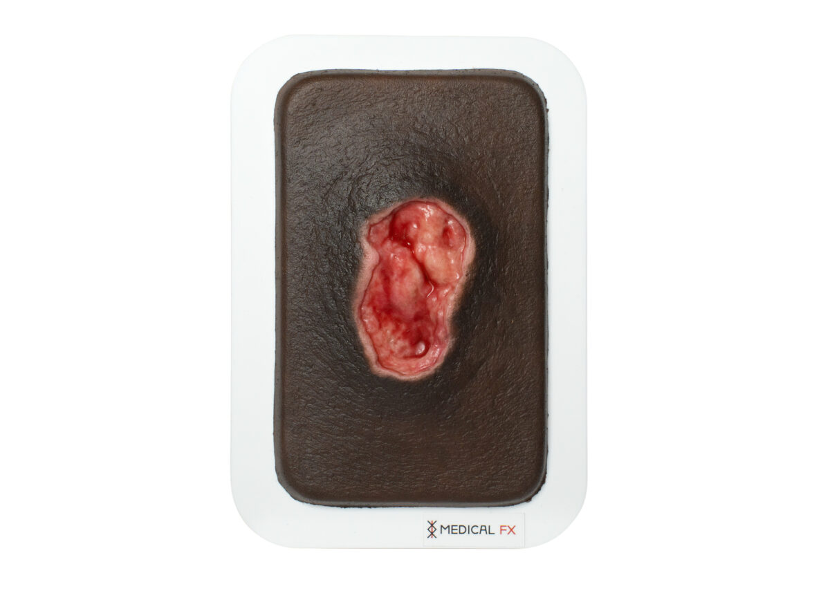 Pocketwunde Dekubitus