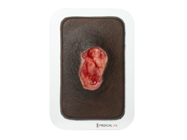 Pocketwunde Dekubitus – Bild 8