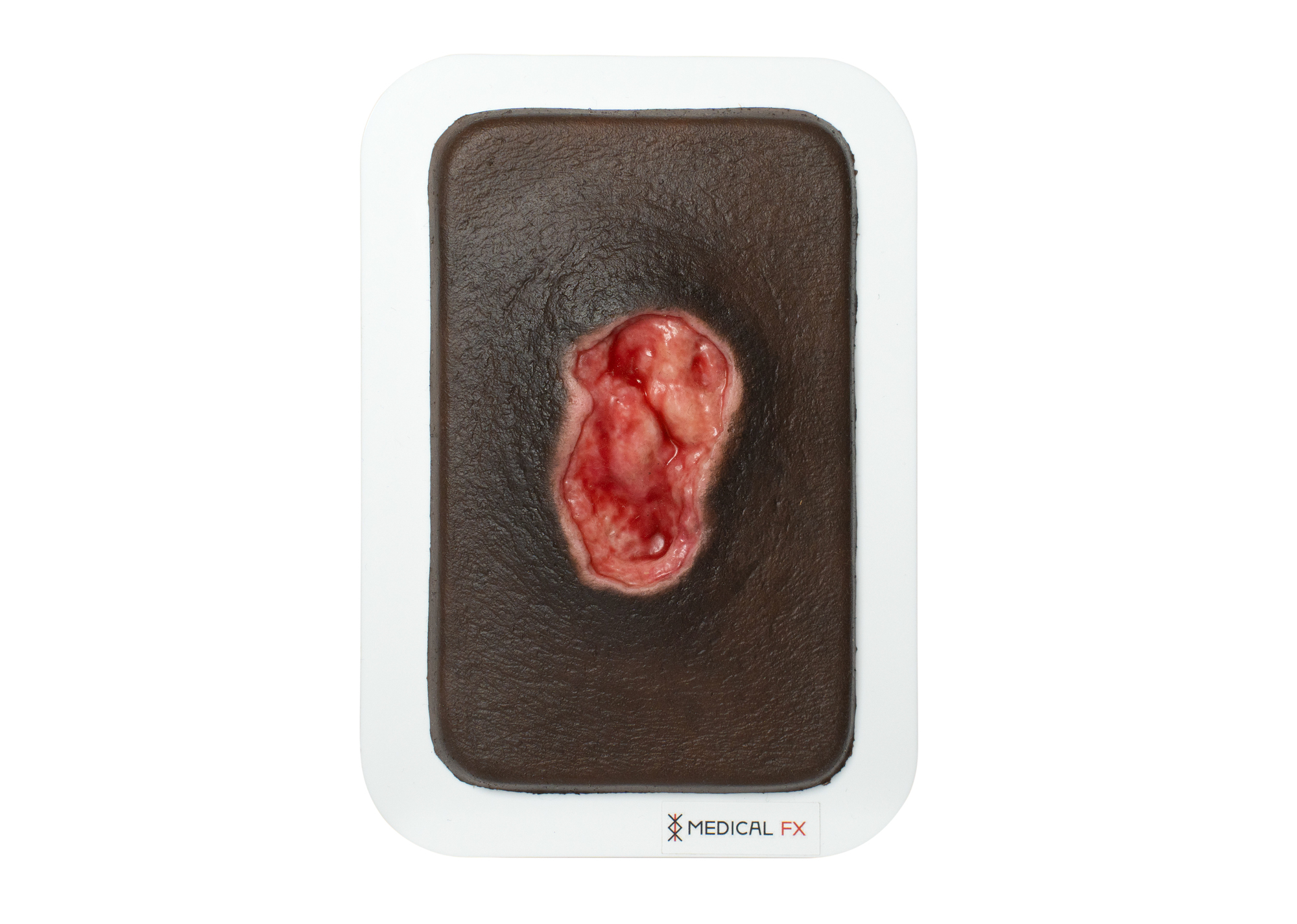 Pocketwunde Dekubitus – Bild 8