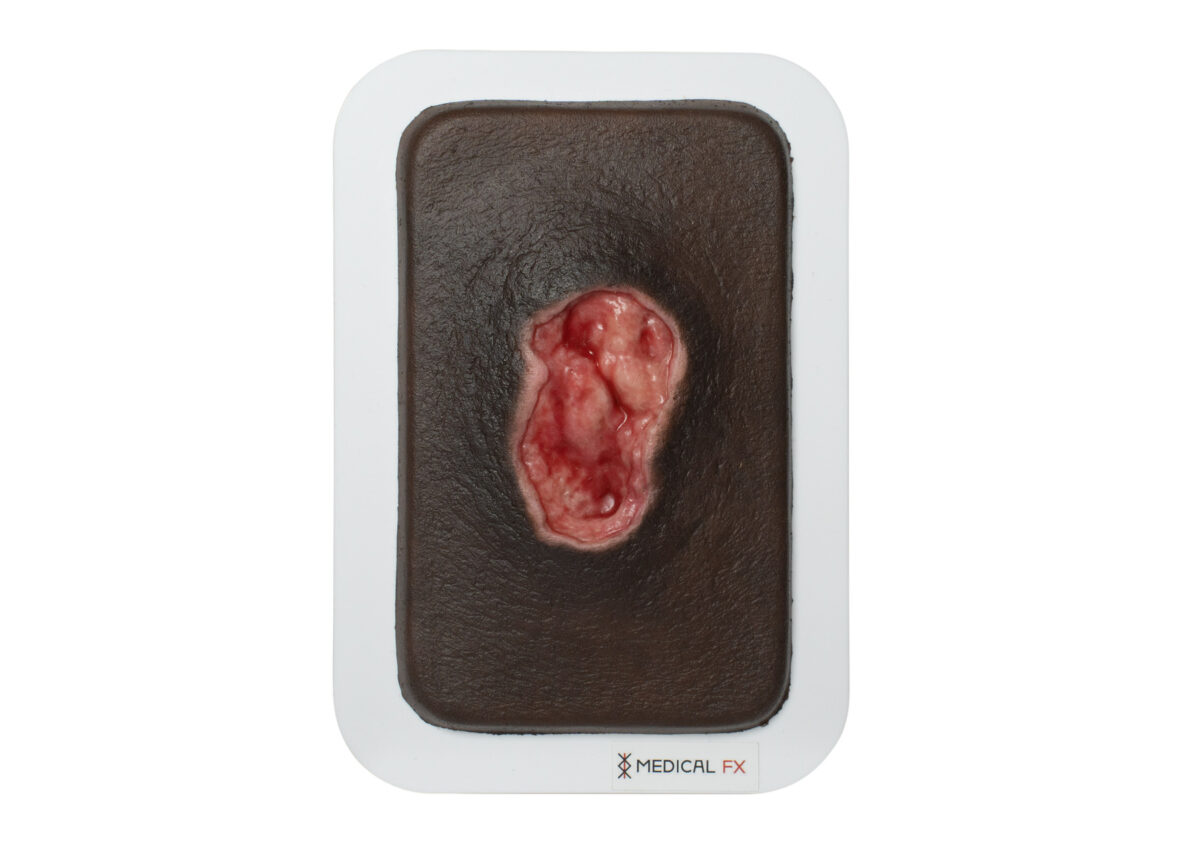 Pocketwound Úlcera por Presión