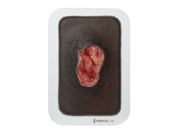 Pocketwound Úlcera por Presión - Image 8