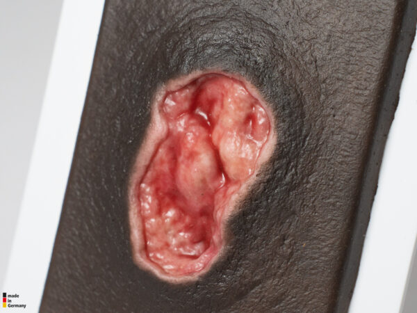 Pocketwound Úlcera por Presión - Image 4