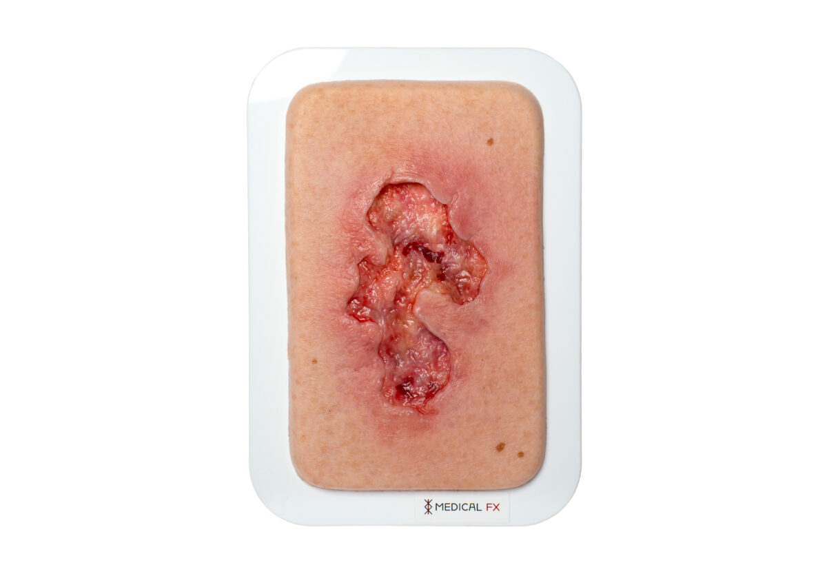 Pocketwunde Ulcer - Chronische Wunde