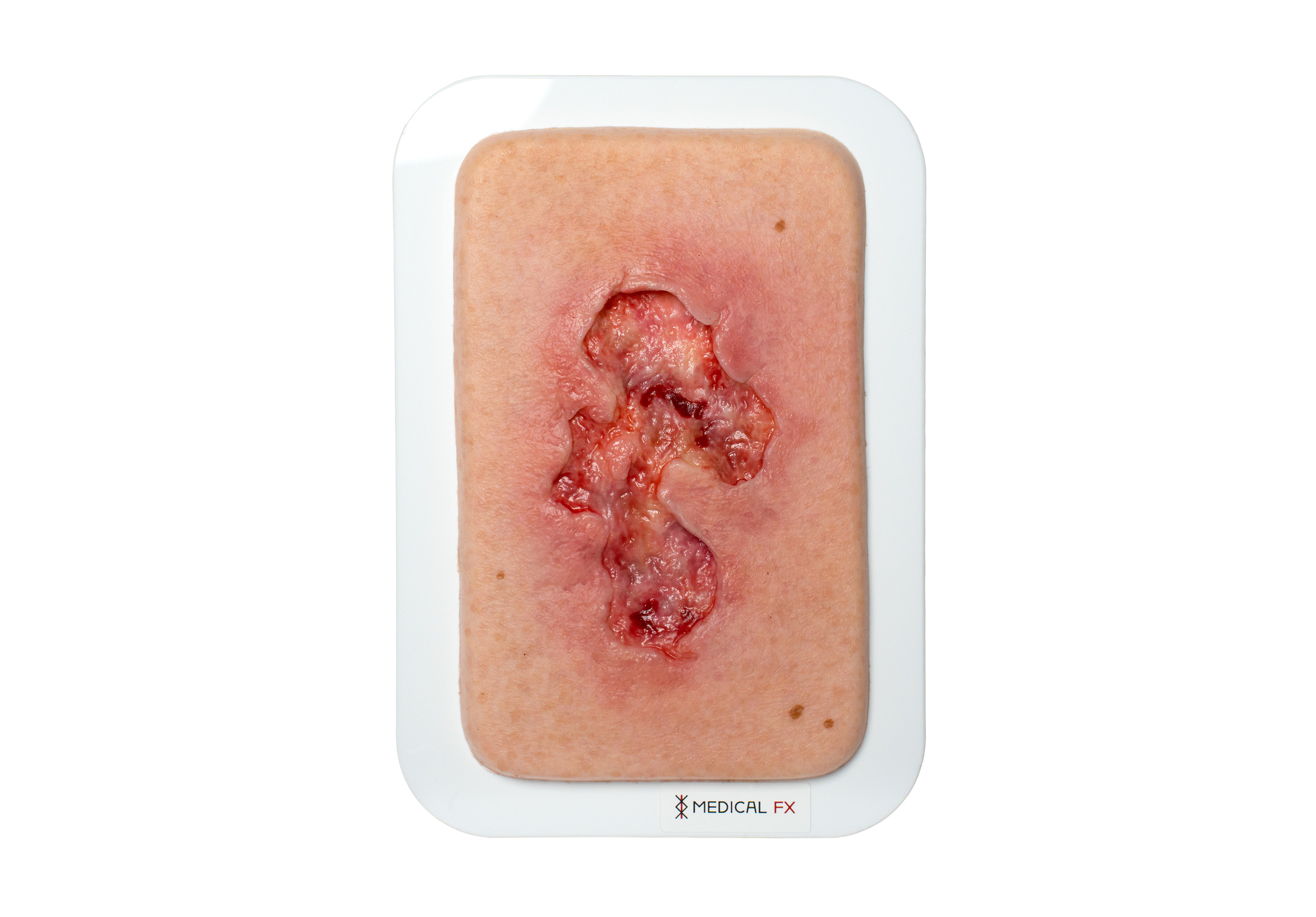 Pocketwunde Ulcer - Chronische Wunde – Bild 1
