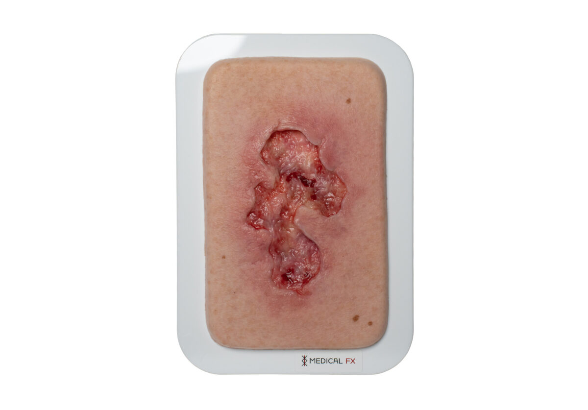 Pocketwound Ulcer - Chronic Wound