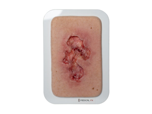 Pocketwound Ulcer - Chronic Wound - Image 9