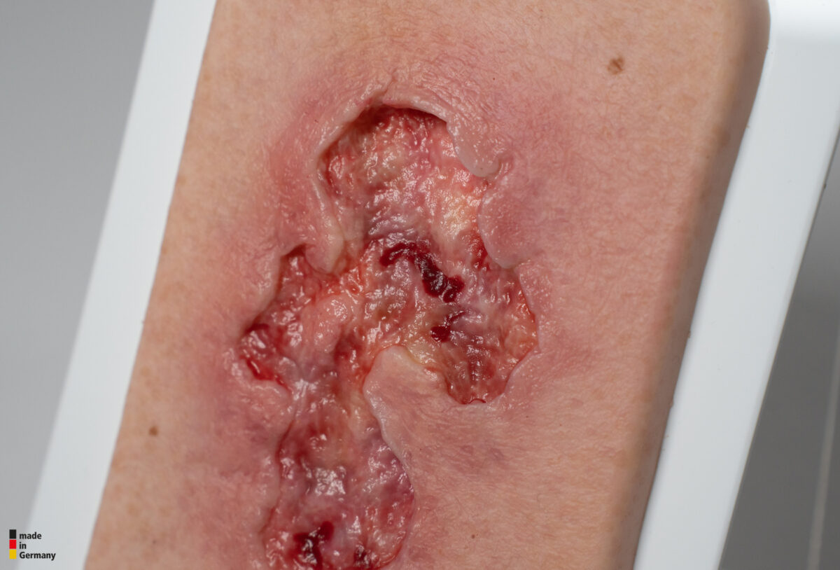 Pocketwound Ulcer - Chronic Wound