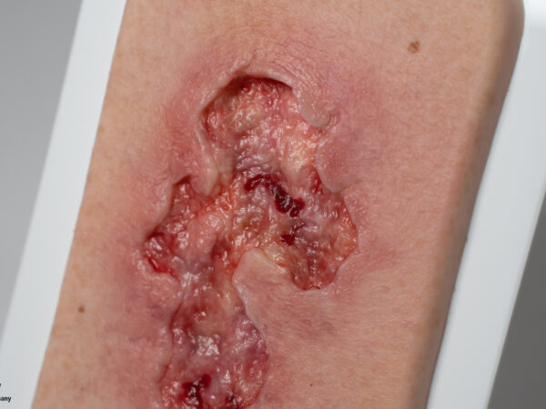 Pocketwound Ulcer - Chronic Wound - Image 2