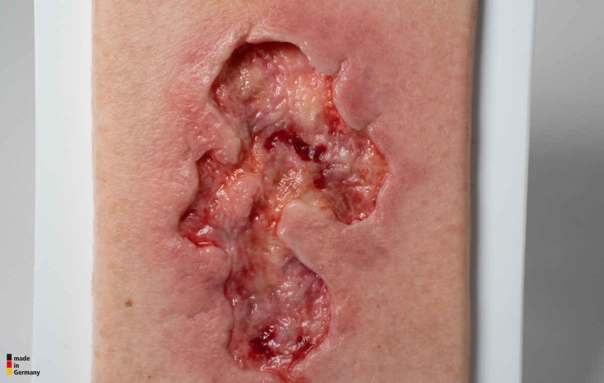 Pocketwound Ulcer - Chronic Wound