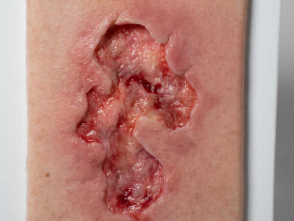 Pocketwound Ulcer - Chronic Wound - Image 3