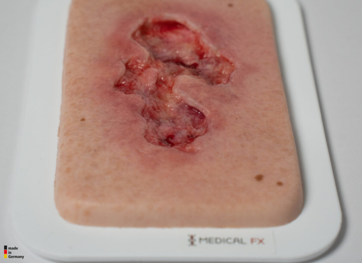 Pocketwound Ulcer - Chronic Wound