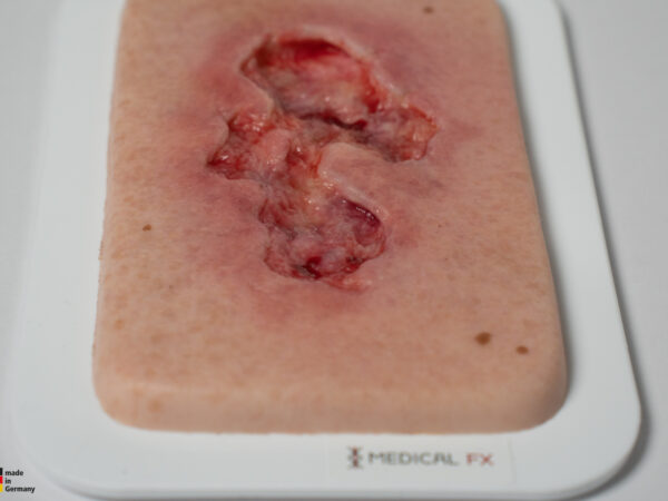 Pocketwound Ulcer - Chronic Wound - Image 4