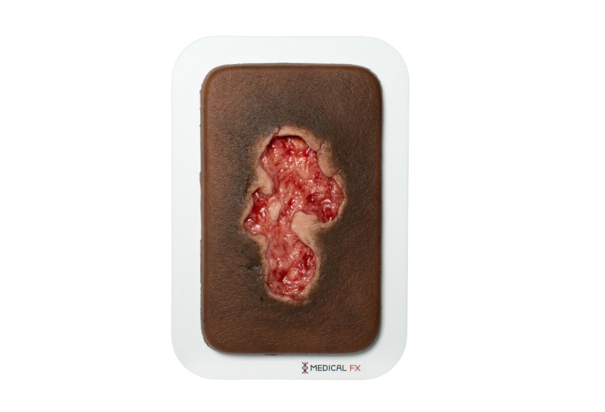 Pocketwunde Ulcer - Chronische Wunde