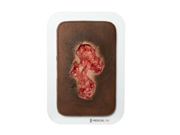 Pocketwunde Ulcer - Chronische Wunde – Bild 9