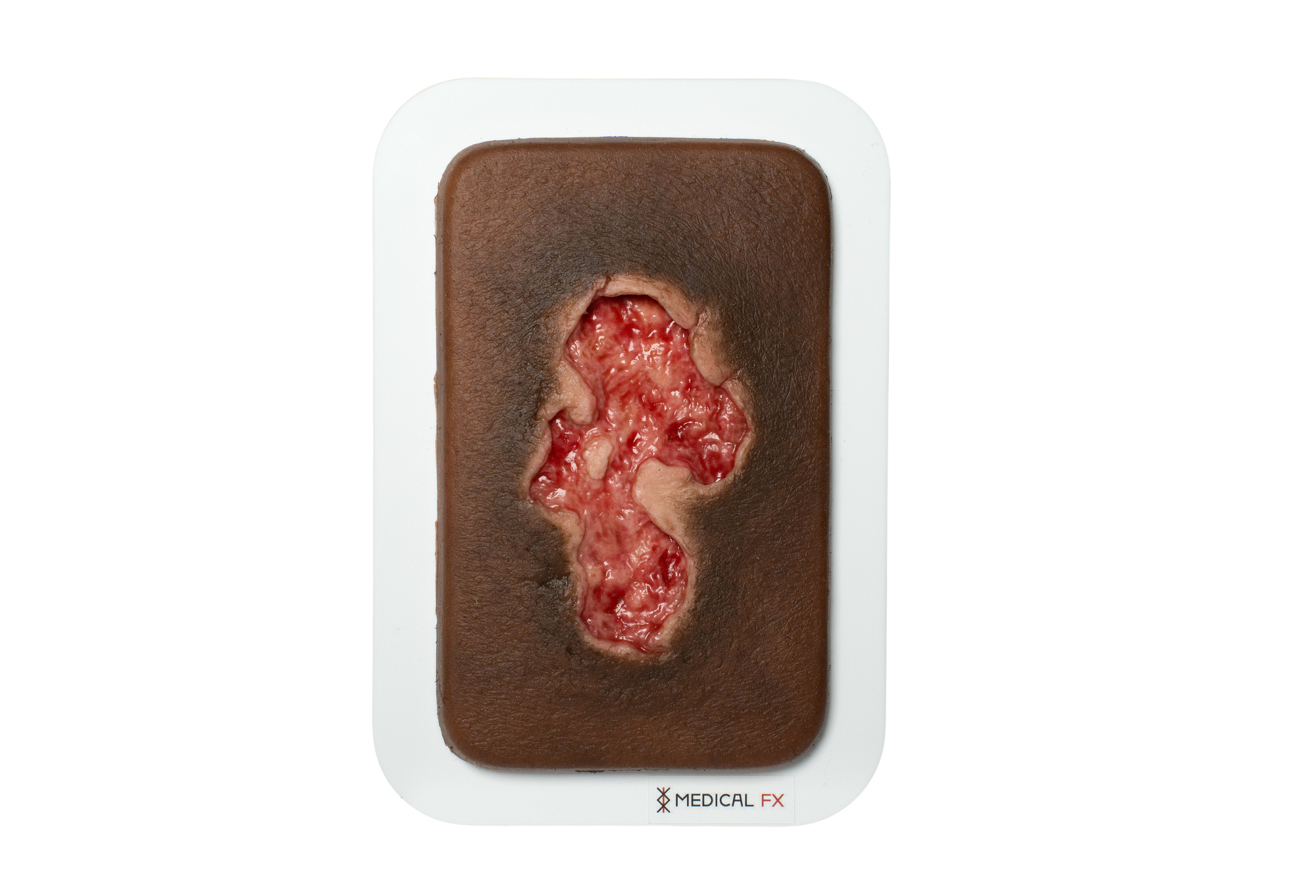 Pocketwunde Ulcer - Chronische Wunde – Bild 9