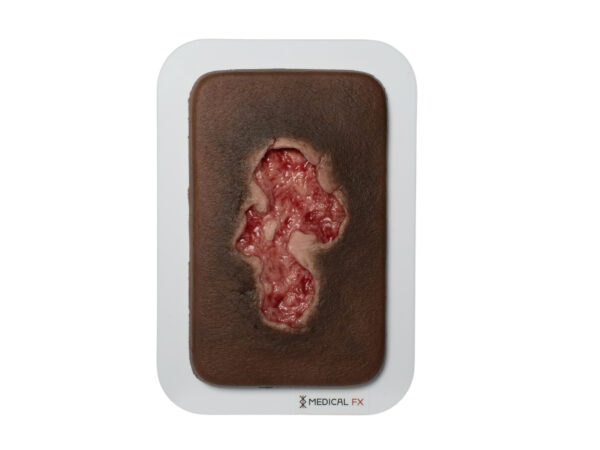 Pocketwound Ulcer - Chronic Wound - Image 10