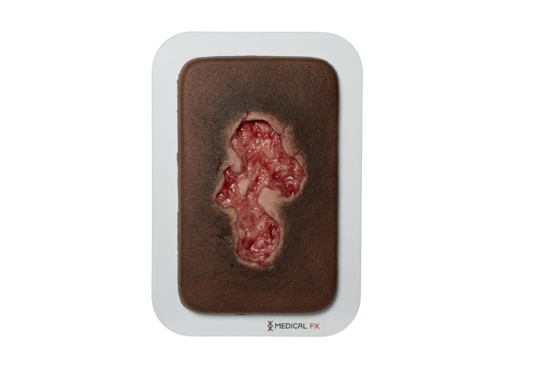 Pocketwound Ulcer - Chronic Wound - Image 10