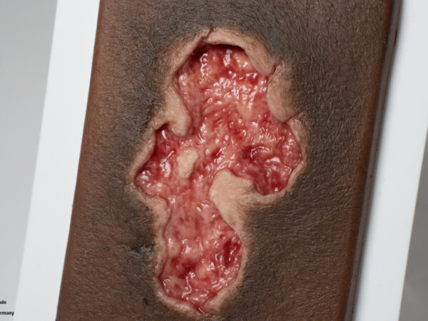 Pocketwound Ulcer - Chronic Wound - Image 5