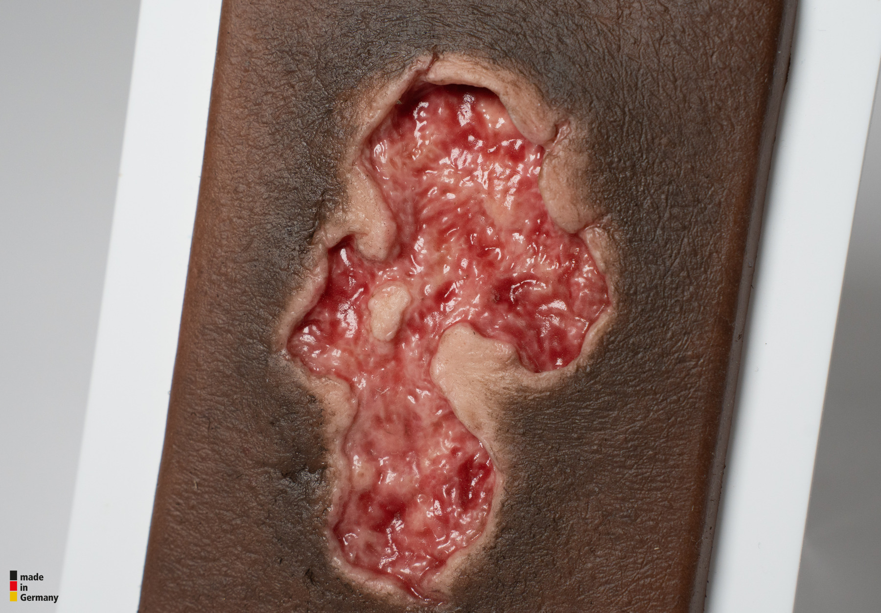 Pocketwound Ulcer - Chronic Wound - Image 5