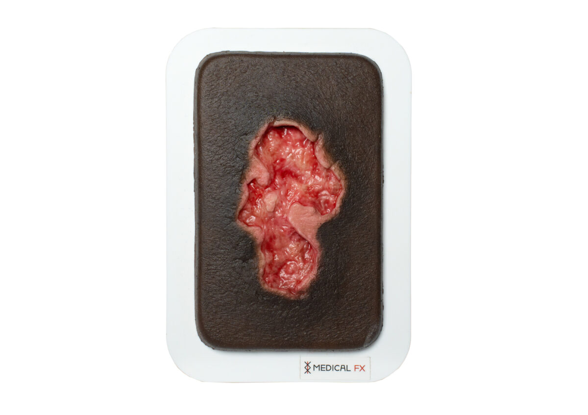 Pocketwunde Ulcer - Chronische Wunde