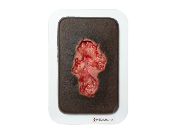 Pocketwunde Ulcer - Chronische Wunde – Bild 10