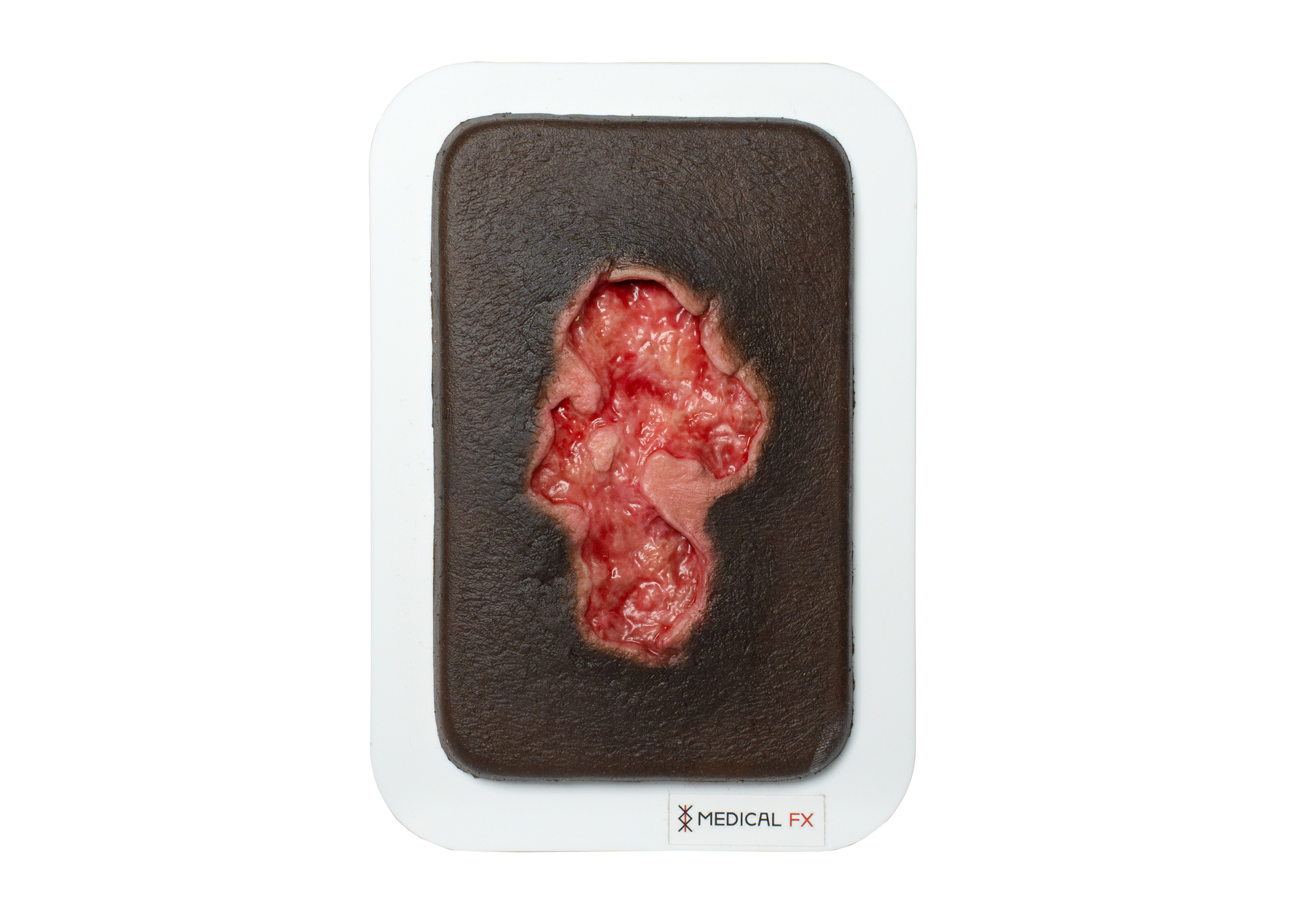 Pocketwunde Ulcer - Chronische Wunde – Bild 10