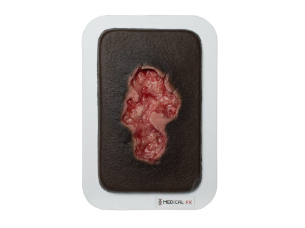 Pocketwound Ulcer - Chronic Wound - Image 11