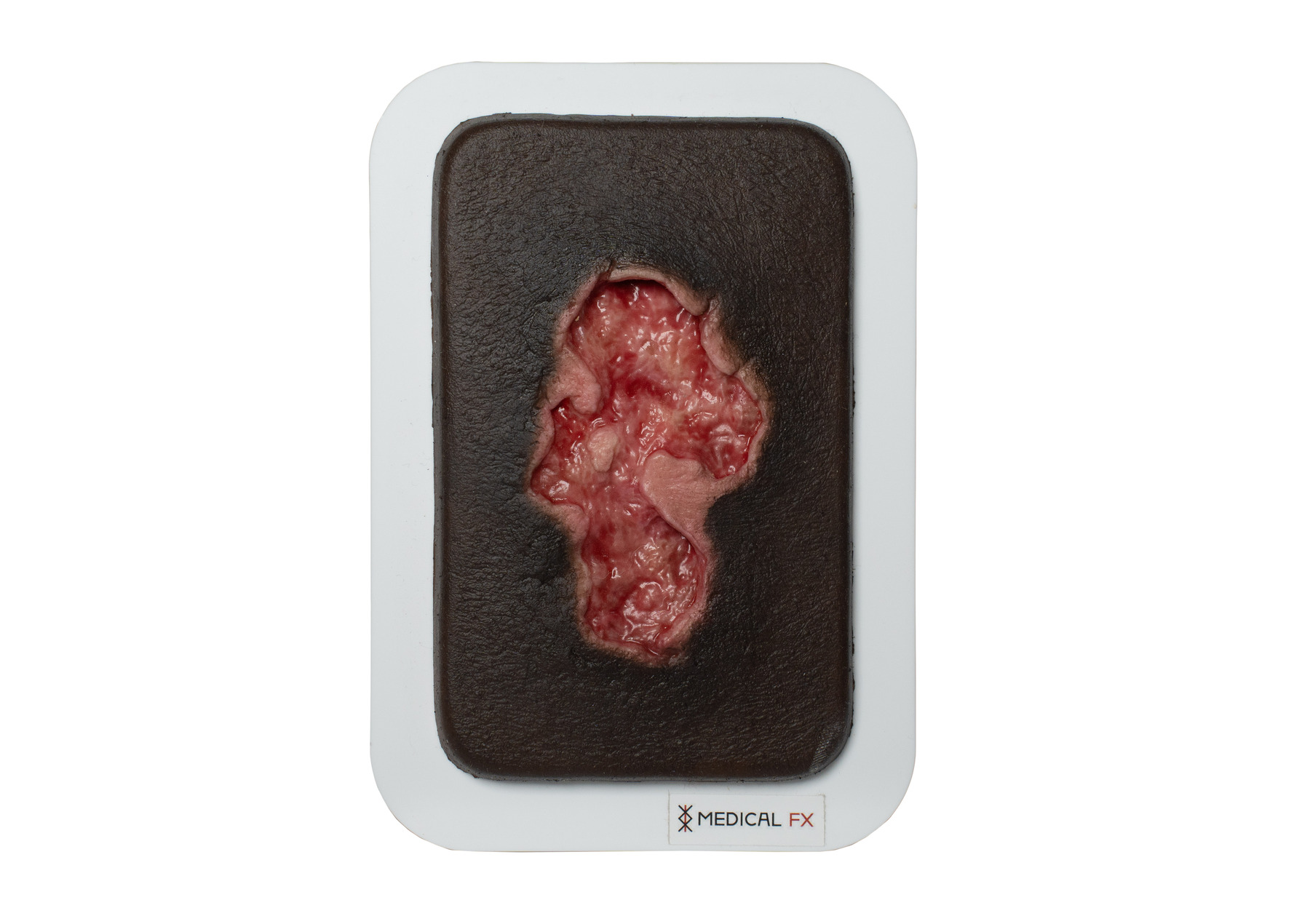 Pocketwound Ulcer - Chronic Wound - Image 11