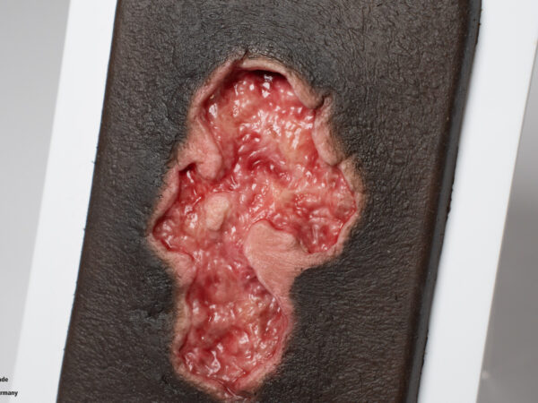 Pocketwound Ulcer - Chronic Wound - Image 6