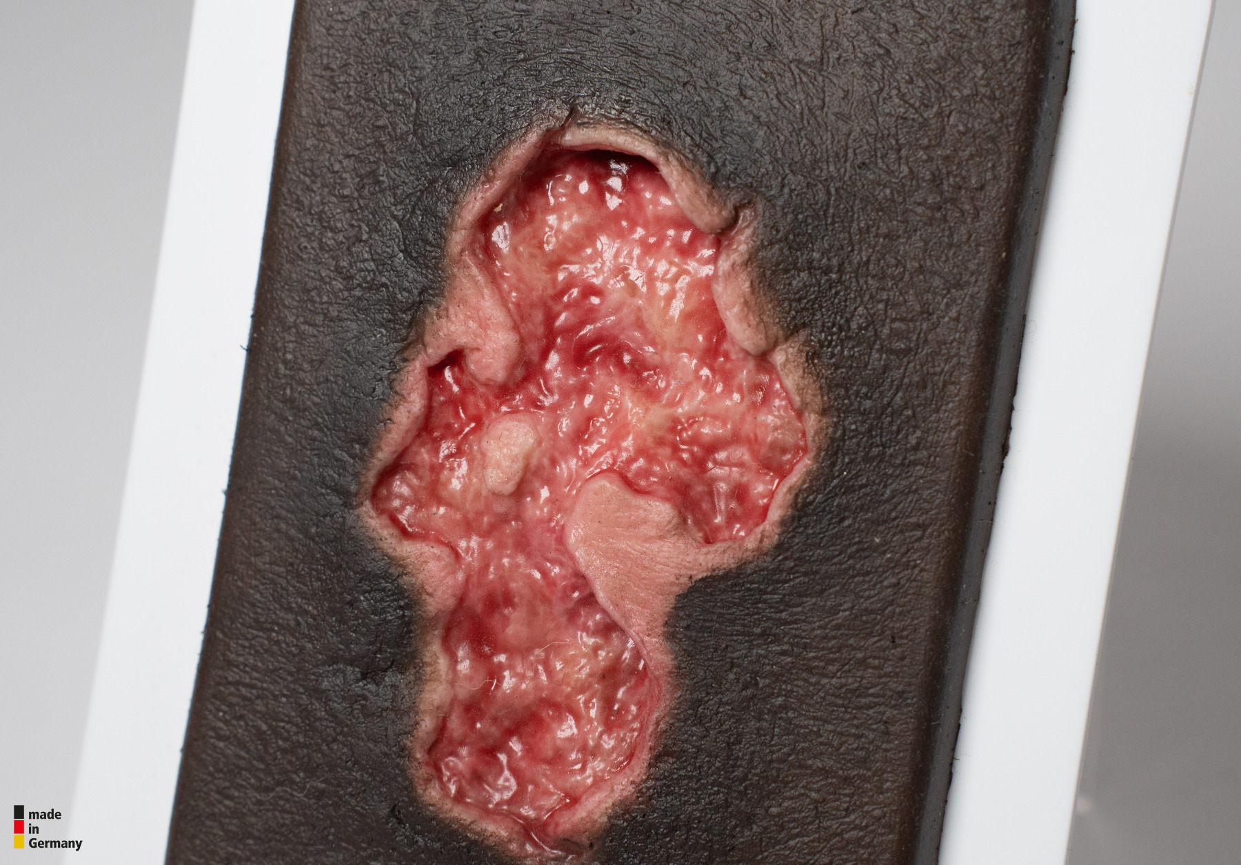 Pocketwound Ulcer - Chronic Wound - Image 6