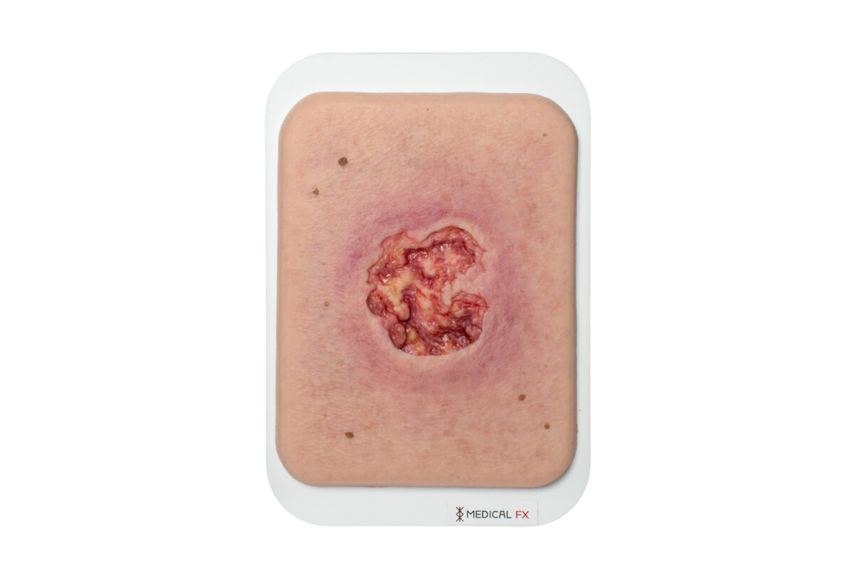 Pocketwunde Ulcer mit größerer Wundumgebung