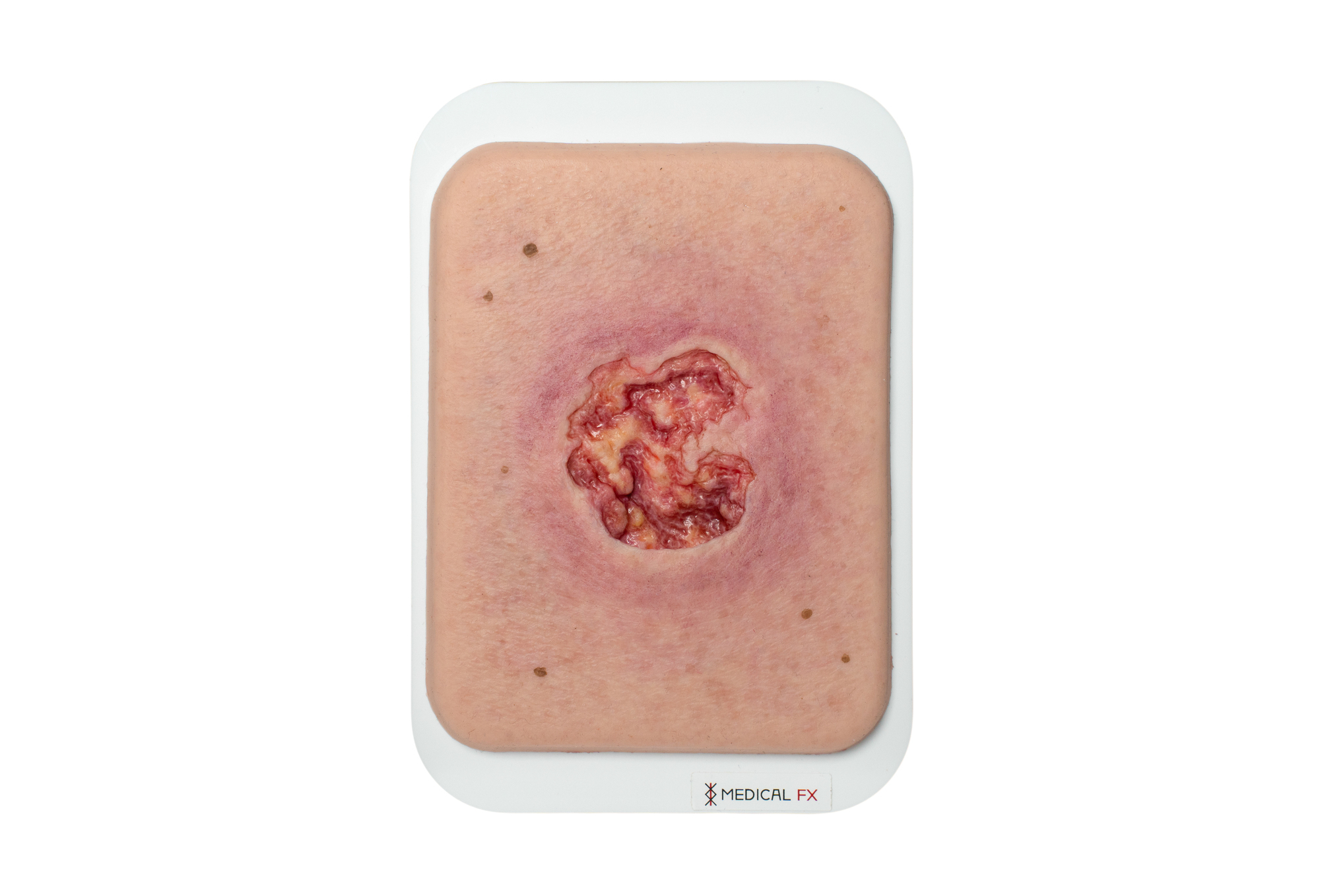 Pocketwunde Ulcer mit größerer Wundumgebung – Bild 1
