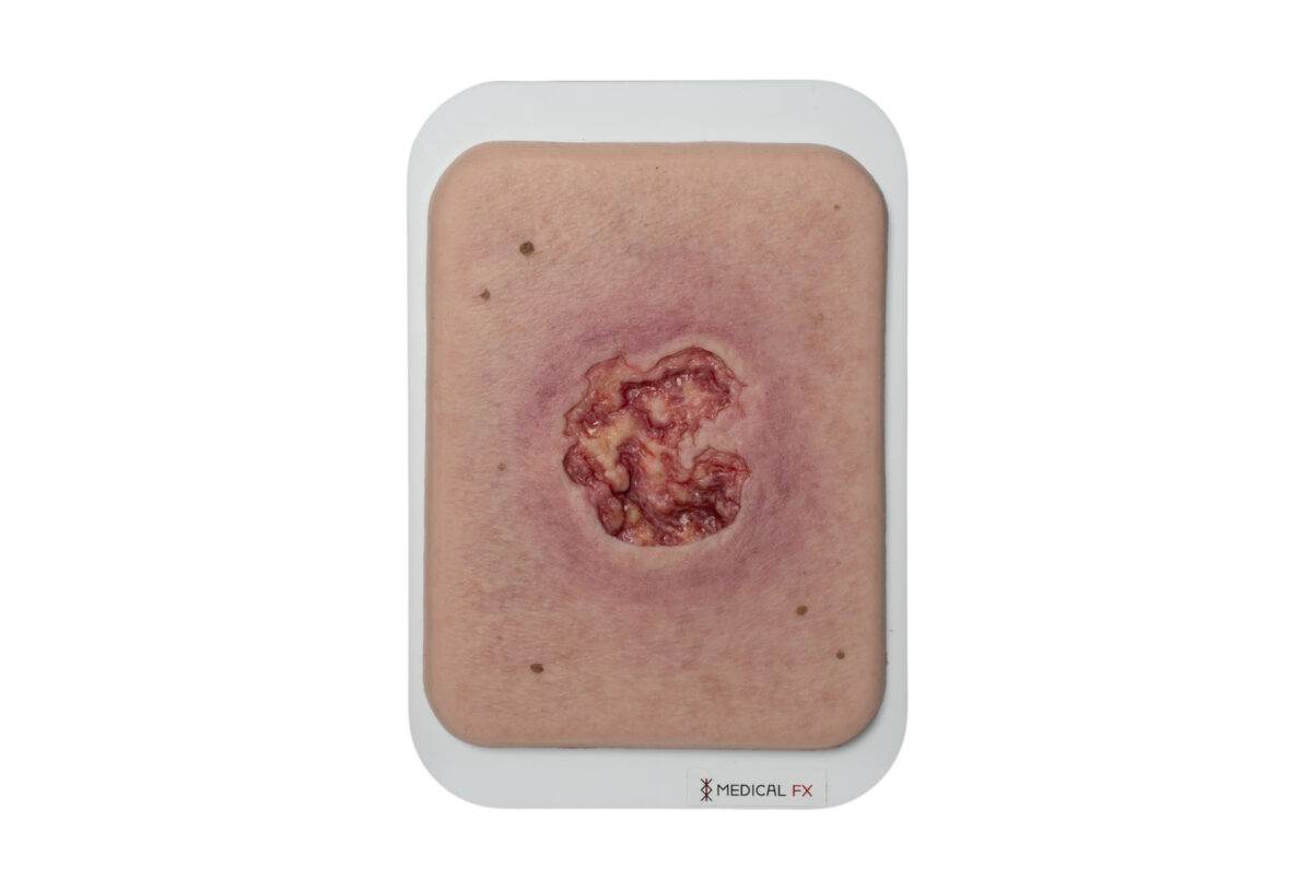 Pocketwound Ulcer with larger periwound skin area