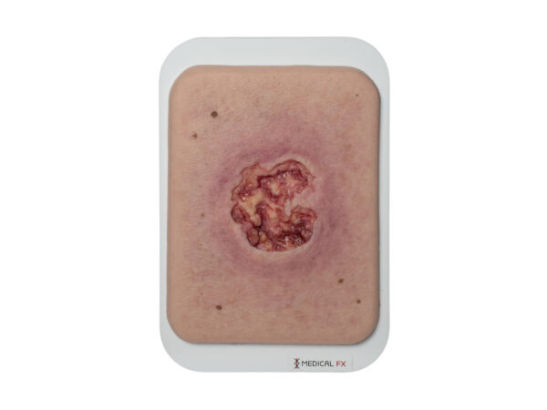 Pocketwound Ulcer with larger periwound skin area