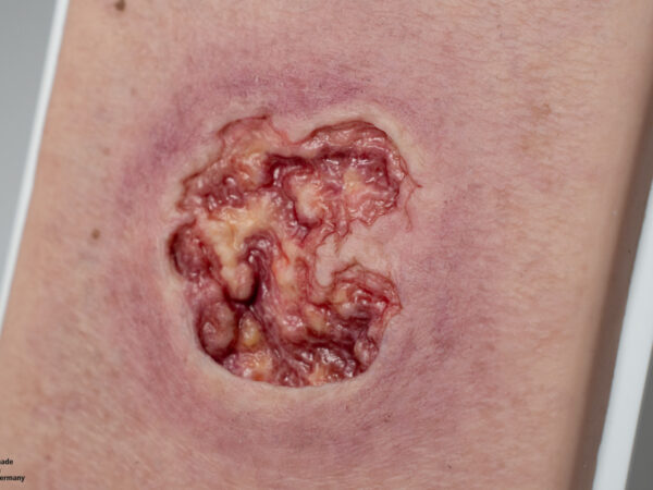 Pocketwound Ulcer with larger periwound skin area - Image 2
