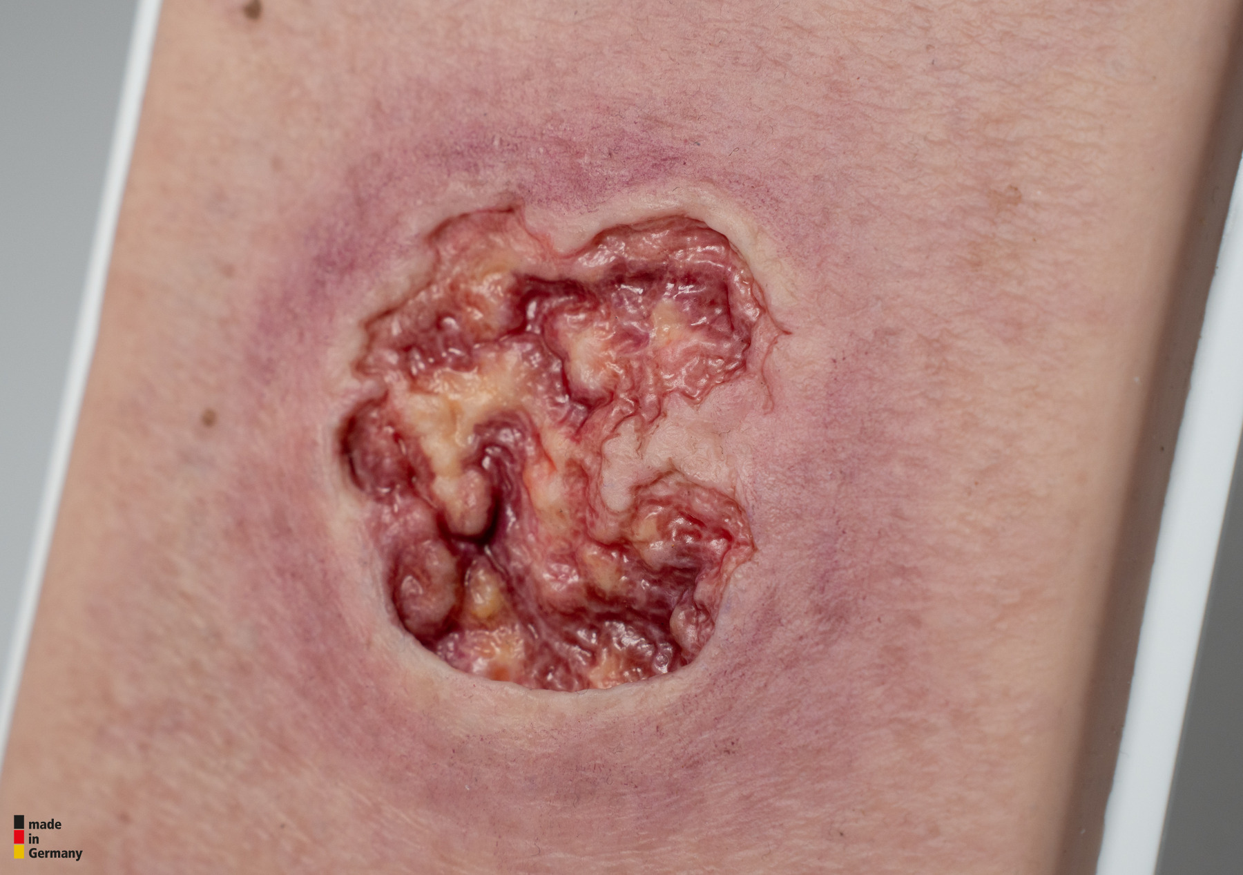 Pocketwound Ulcer with larger periwound skin area - Image 2