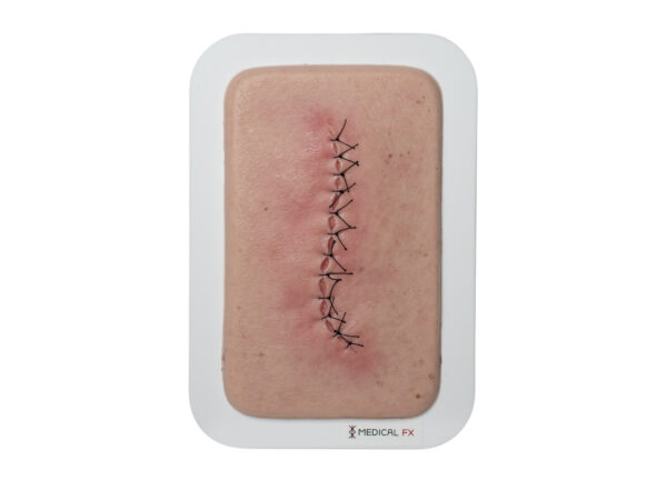 Pocketwound Surgical Wound Closed and Inflamed